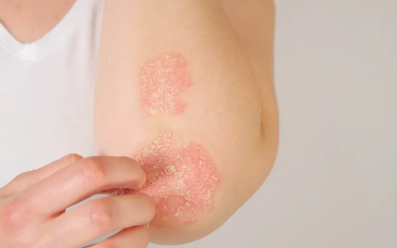 Psoriasis