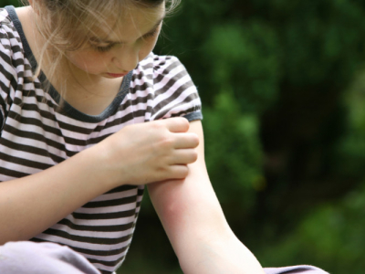 Comment soulager les piqûres de moustiques? 