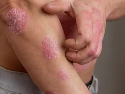 Psoriasi: comprendere le vere cause e alleviare naturalmente